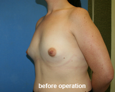 plastic-surgery-breast-augmentation